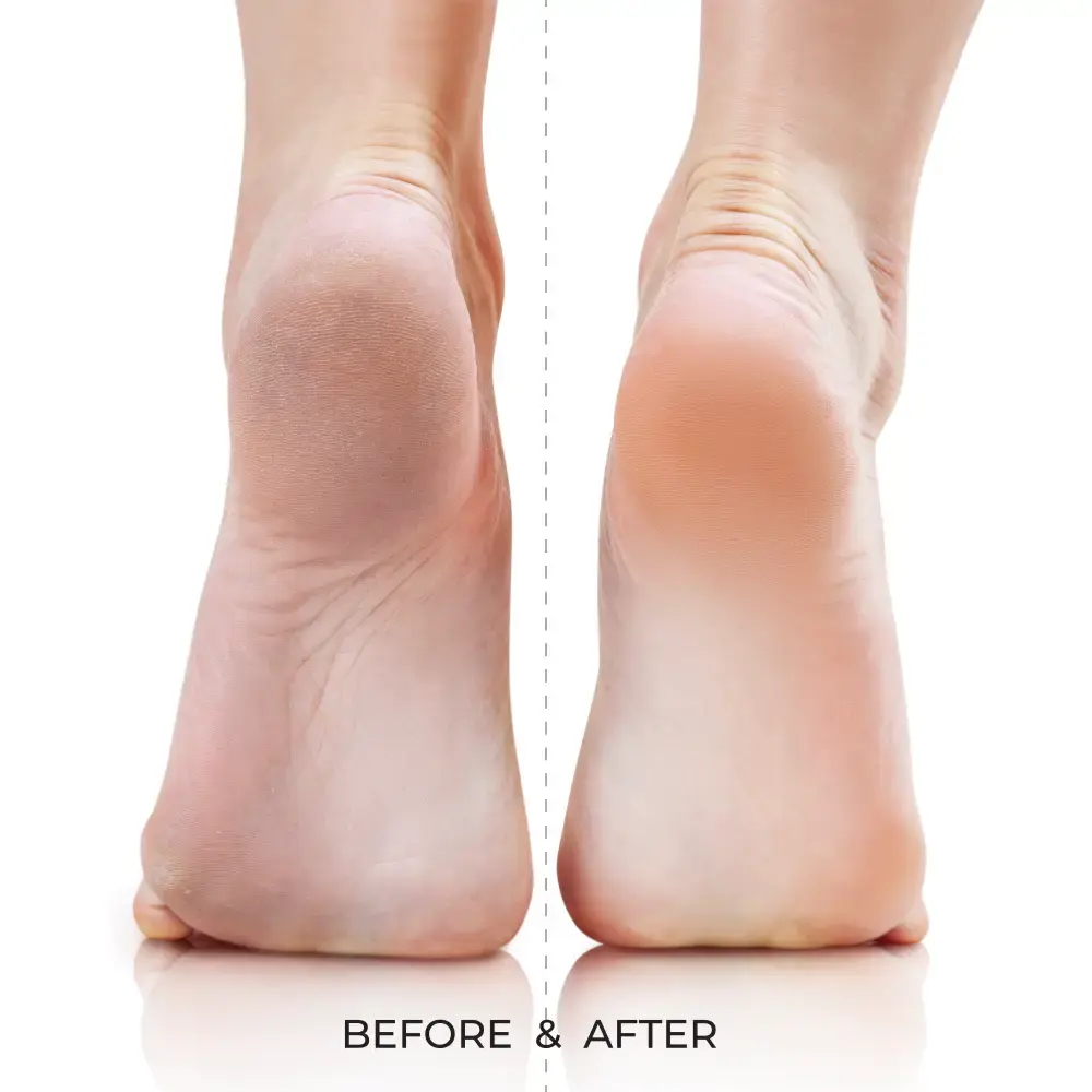Kiss New York Dual-Sided Foot File for Callus Removal and Smooth, Soft Feet - Image 29